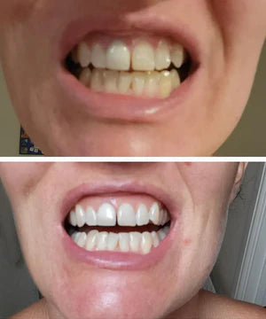 Purple Teeth Whitening Strips